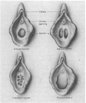 Hymen Types